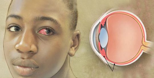 Ilustração de olho com uveíte e anatomia interna
