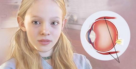 Ilustração de criança com estrabismo e anatomia ocular