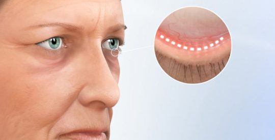 Detalhe de plástica ocular na região das pálpebras